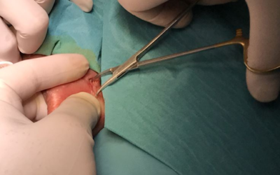 Quem pode fazer a Vasectomia?